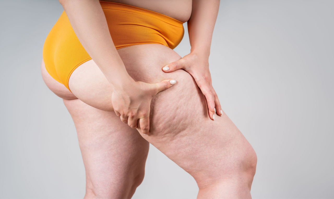 Lipedema Entenda o que é seus sintomas e como trata la Minha Cirurgia