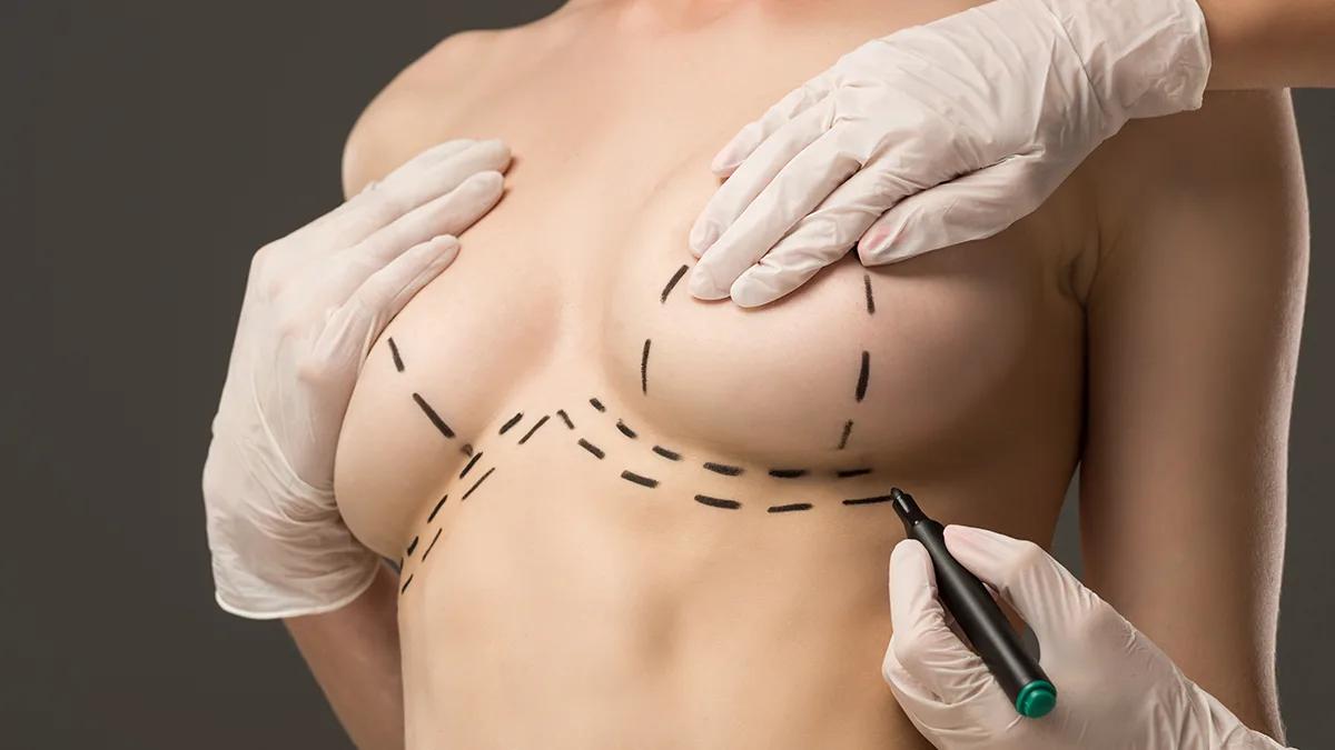 Como é o antes e depois da mamoplastia?