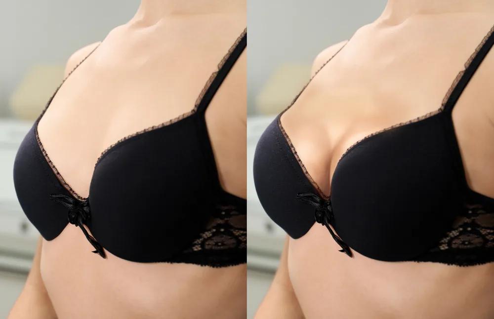 Como é o antes e depois da mamoplastia?